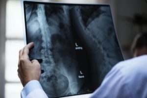 Doctor holding up X-ray of spine